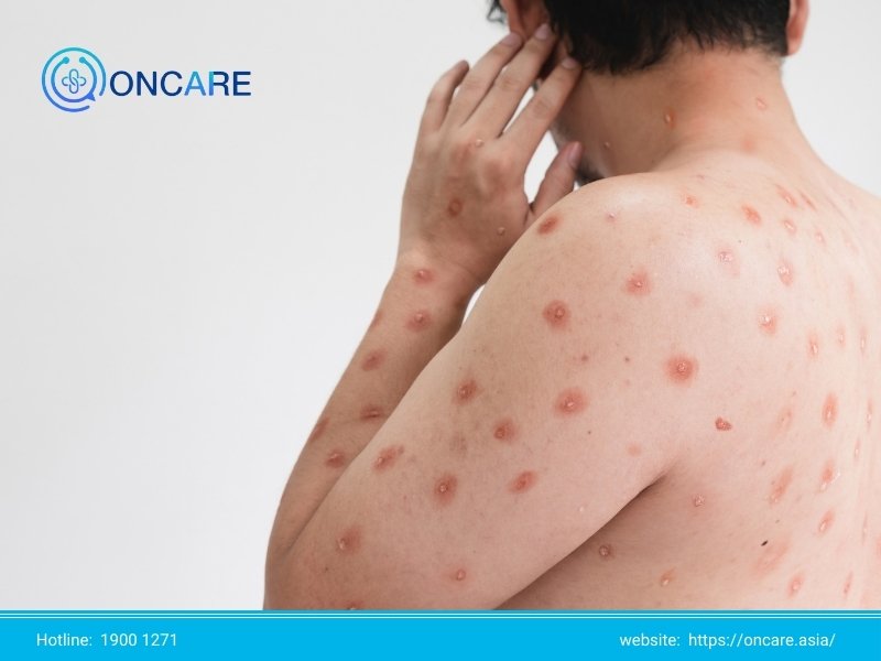 Bệnh đậu mùa khỉ: Dấu hiệu, triệu chứng và cách xử lý