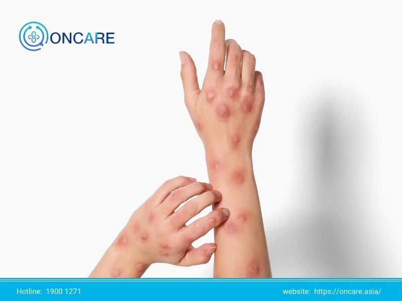 Bệnh đậu mùa khỉ: Dấu hiệu, triệu chứng và cách xử lý